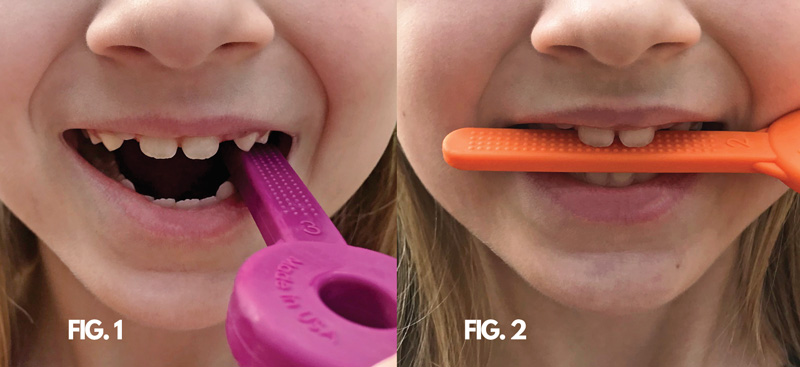 Oral Motor Exercises with Bite Blocks Oral Motor Exercises with Bite Blocks